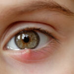 Чи можна давити ячмінь