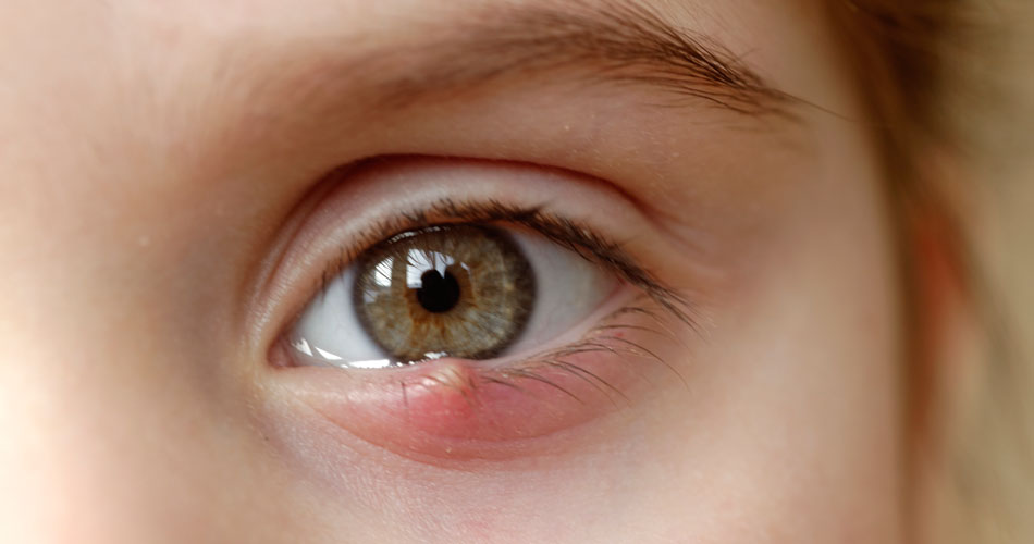 Чи можна давити ячмінь на оці: ризики, лікування та як не нашкодити собі