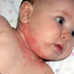 Дисгідротична екзема