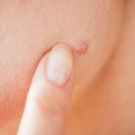 що означають родимки на обличчі