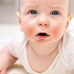 У дитини щоки червоні та шорсткі