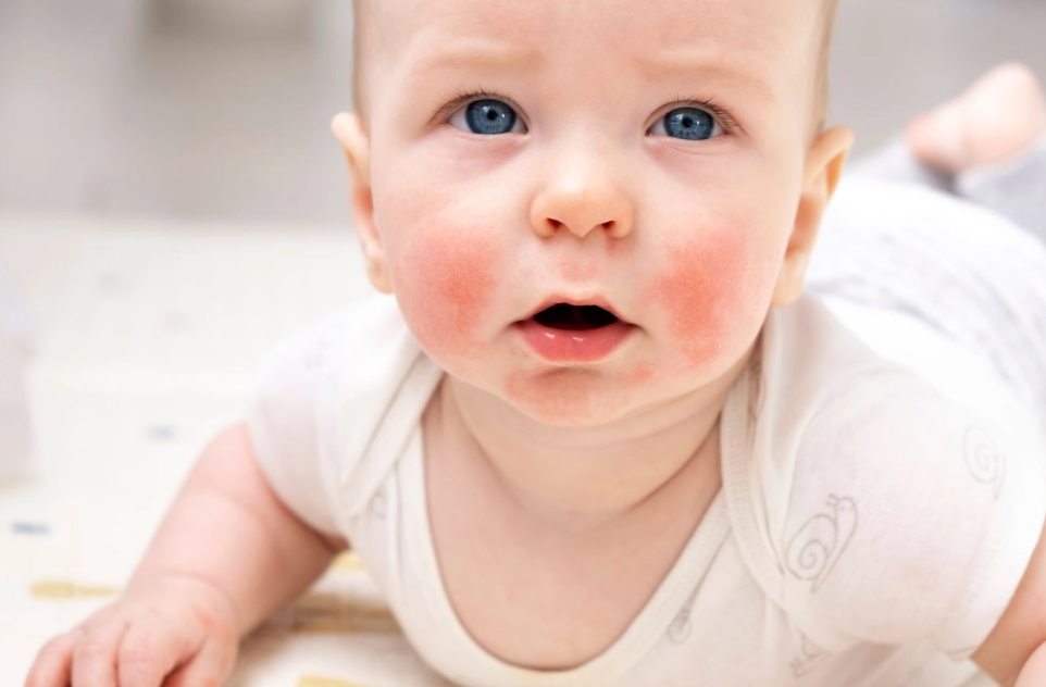 У дитини щоки червоні та шорсткі